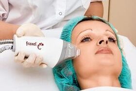 laserowe frakcyjne odmładzanie skóry twarzy