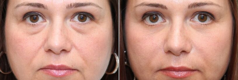 Przed i po blefaroplastyce - usunięcie tłustego ciała pod oczami i ujędrnienie skóry