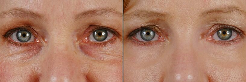 Przed i po zabiegu laserowym - odmładzanie skóry wokół oczu