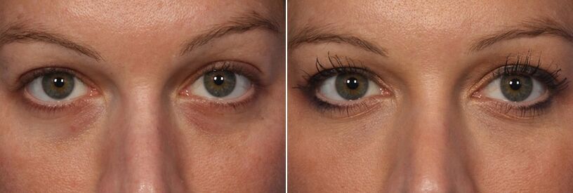 Przed i po zastosowaniu wypełniaczy do wstrzykiwań - redukcja cieni pod oczami